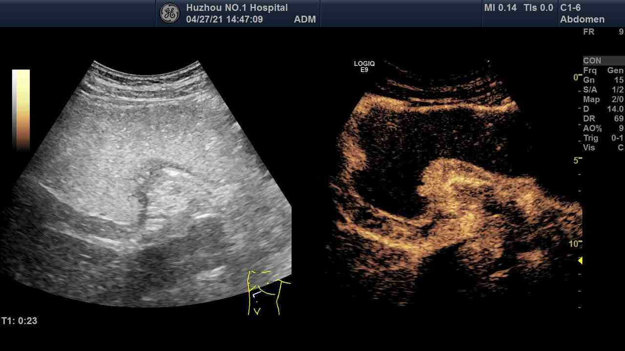 Ultrasound Case 3